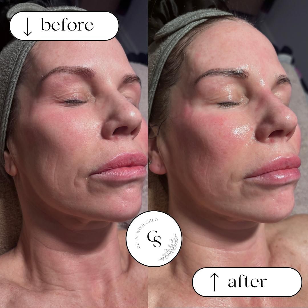 Before and after on mature skin, showing a plumper texture