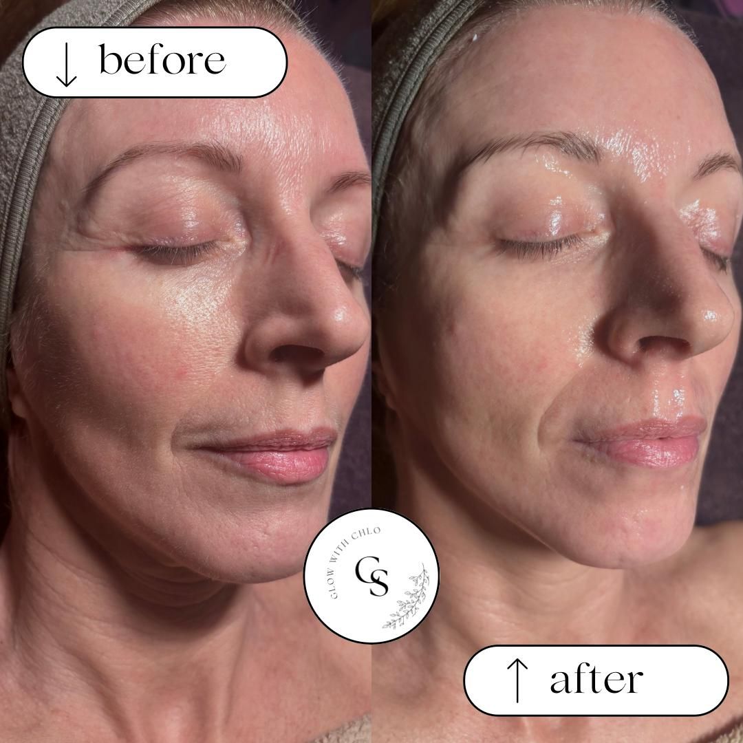 Before and after a Deluxe Mesotherapy & Dermaplaning facial, showing smoother, brighter skin