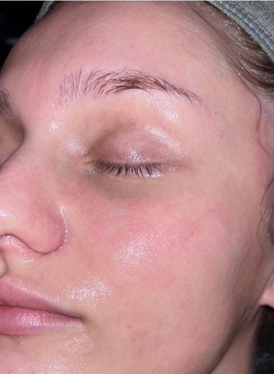 Client with bright, smooth, glowing skin after dermaplaning