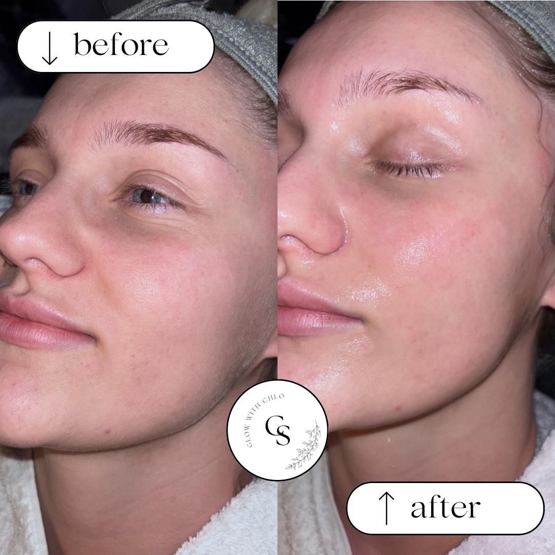 Before and after dermaplaning, showing brighter, more even skin