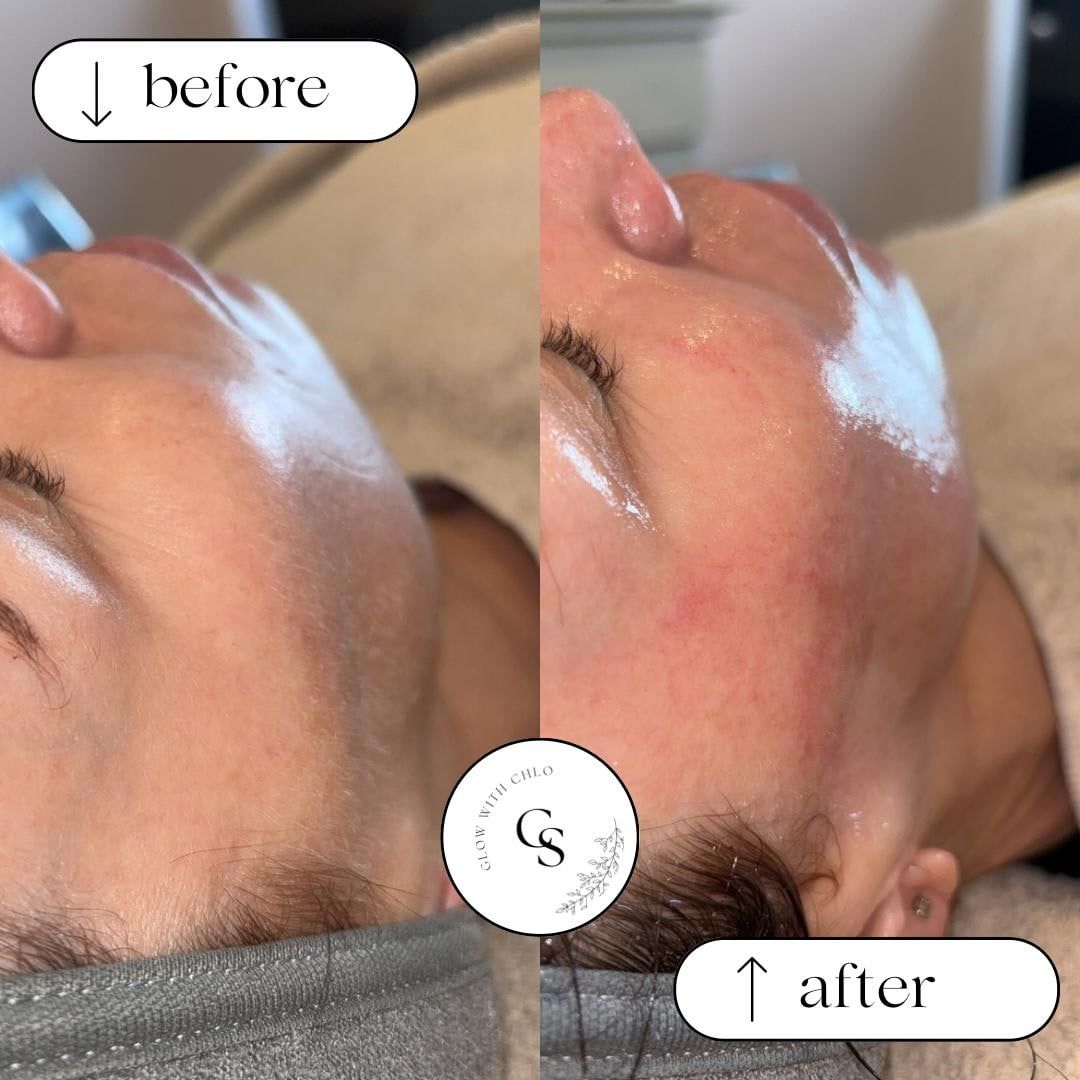 Before and after a facial, showing smoother skin along the jaw