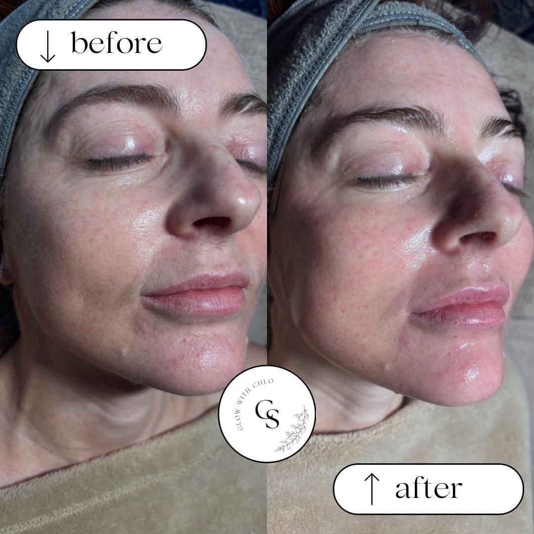 Before and after a Mesotherapy & Dermaplaning facial